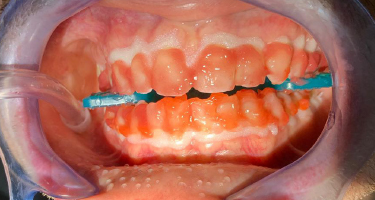 40%-Wasserstoffperoxid dringt in die Zahnoberfläche und beseitigt Verfärbungen