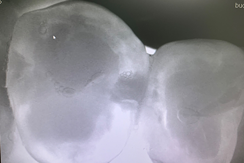 Aufnahme eines Zahnes mit der Kariesdetektor-Laserlampe